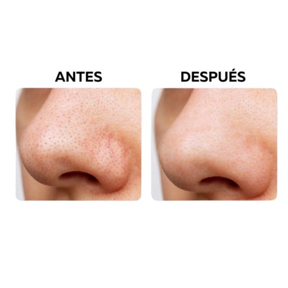 Tira Removedora de Puntos Negros Pack X6 Unidades Simple & Beauty
