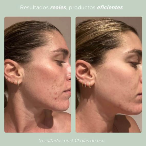 Gel de Limpieza Acné Ácido Salicílico & Tea Tree 150ml Veganis