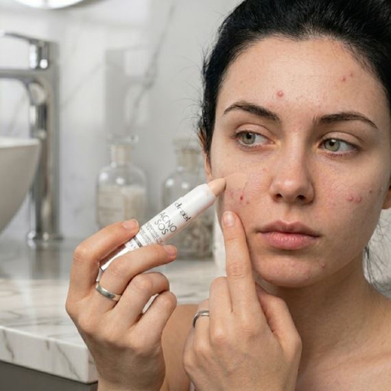 Lápiz Secativo Acné Color Natural ACNO SOS 4,5g Idraet